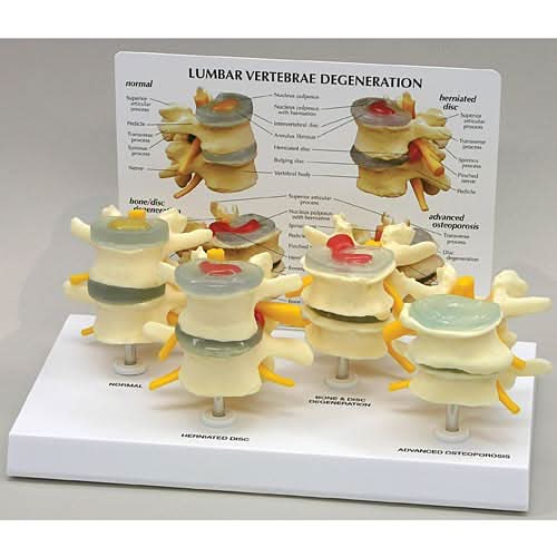 4-Stage Vertebrae Model Set